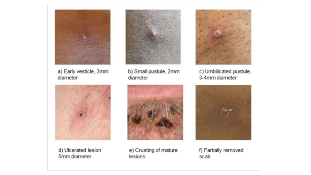 Examples of rashes caused by MPX