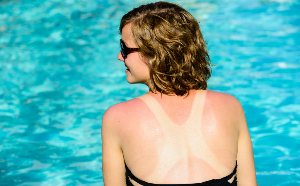 Woman sitting poolside turned away with a sunburn on her back.